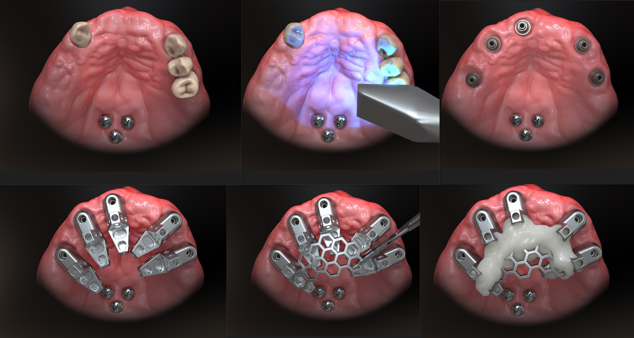 OPTISPLINT 4-Body Scan Kit