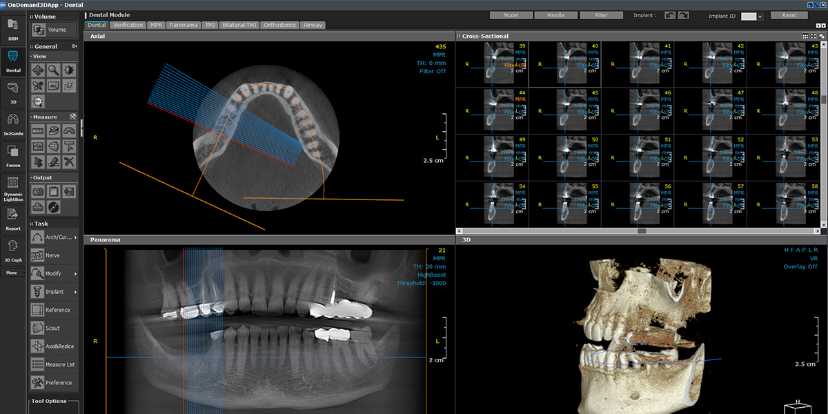 Software OnDemand3D interpretare CBCT